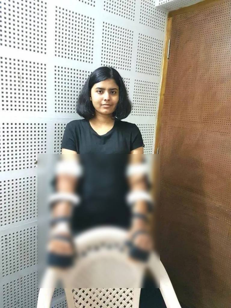 El caso de Shreya Siddanagowda: Un trasplante de brazos de hombre que se adaptó a su cuerpo femenino 3 Shreya Siddanagowda - Shreya Siddanagowda