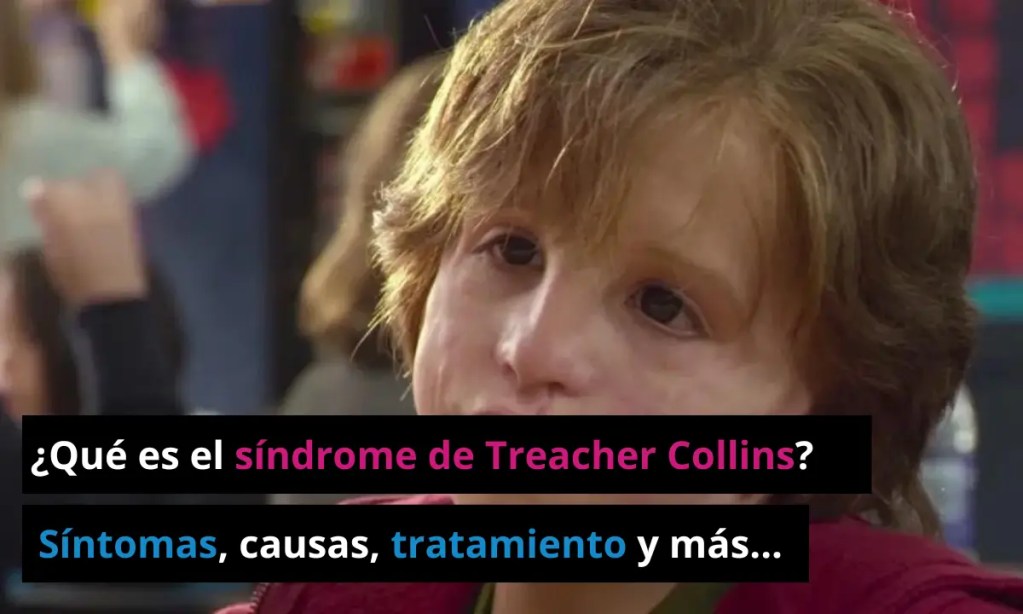 sindrome-de-Treacher-Collins