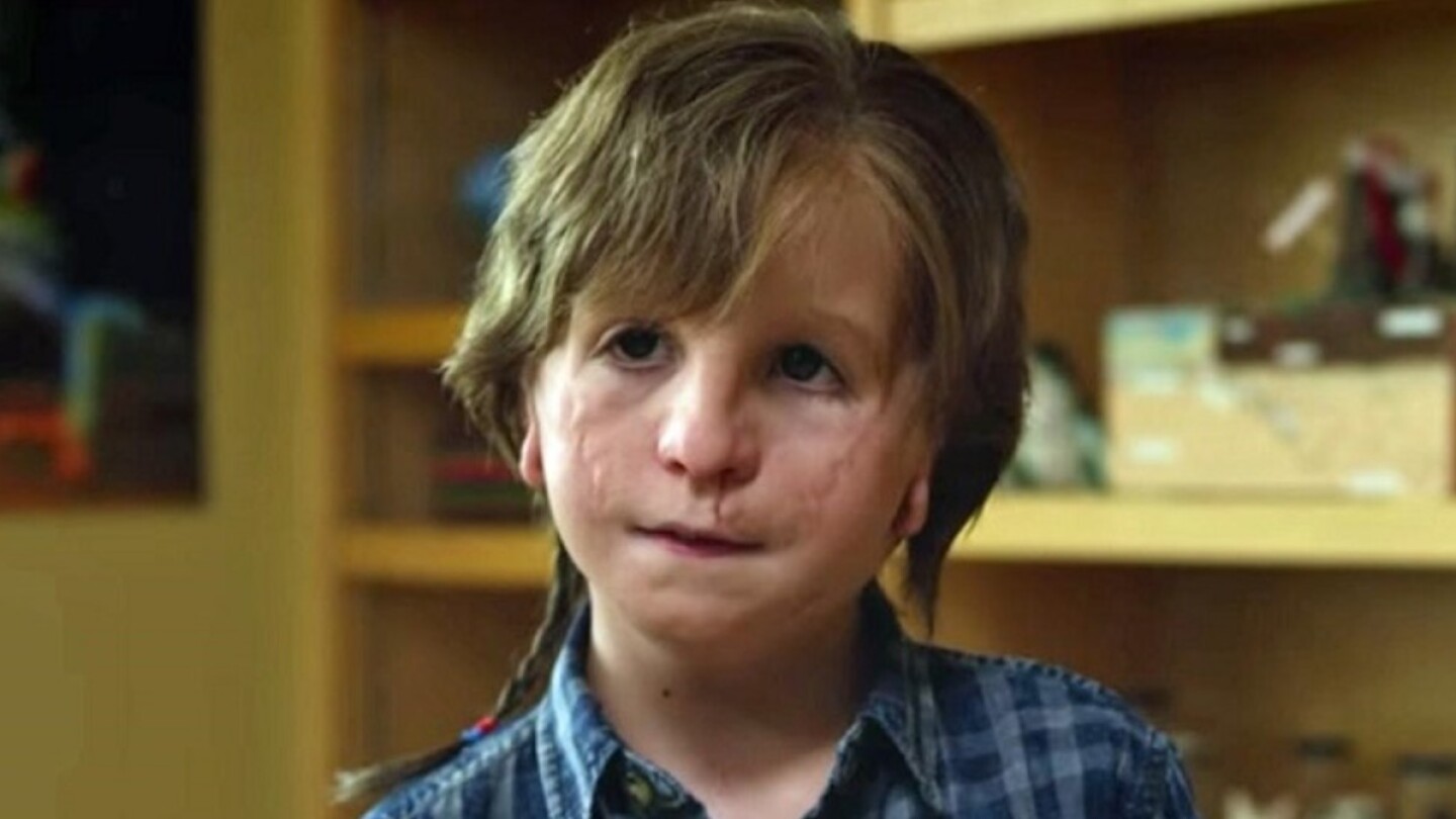 síndrome de Treacher Collins