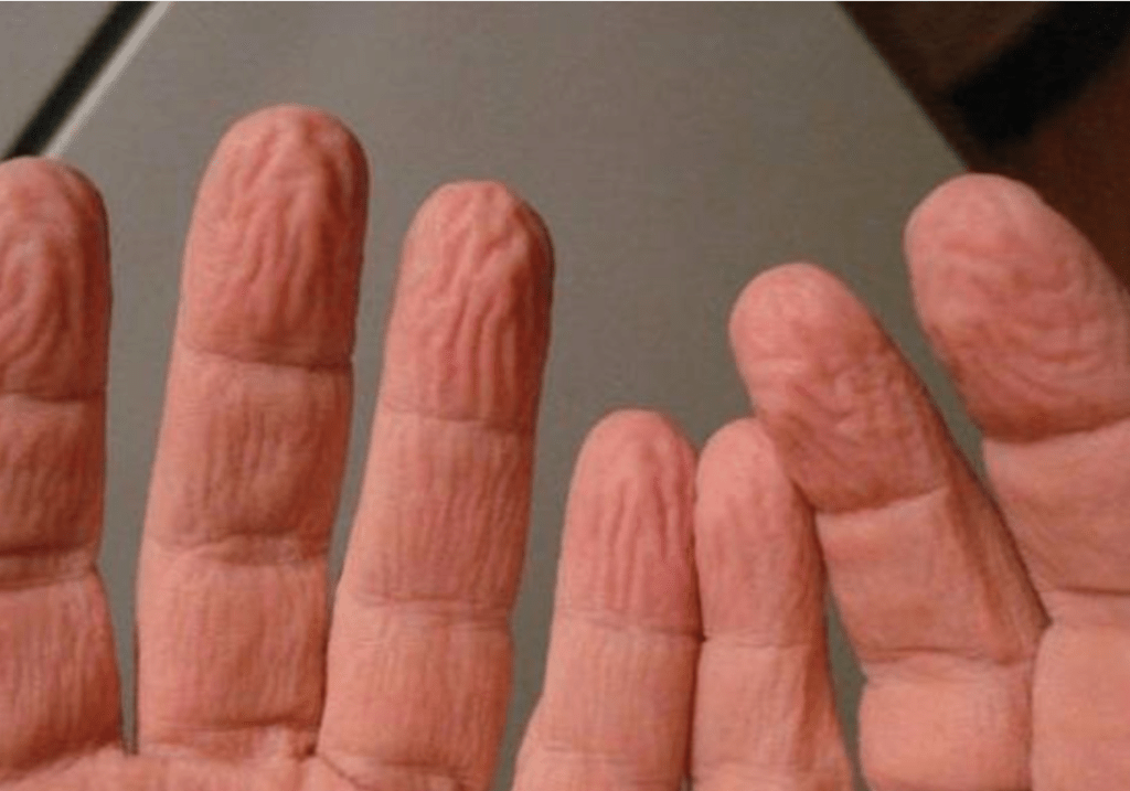 ¿Por qué se arruga la piel de los dedos bajo el agua? Aquí está el motivo