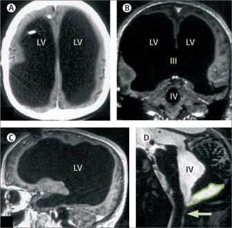 El extraño caso del hombre que vivía sin el 90% de su cerebro