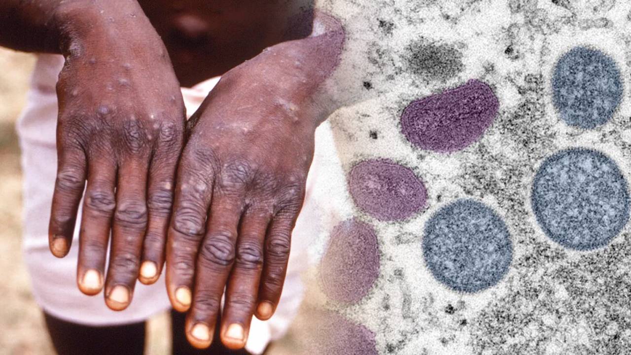 Viruela del Mono declarada emergencia de salud pública en África y causa alerta mundial