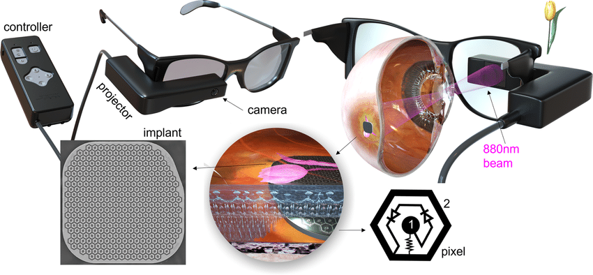 Implante ocular permite a personas con pérdida de visión leer y resolver crucigramas