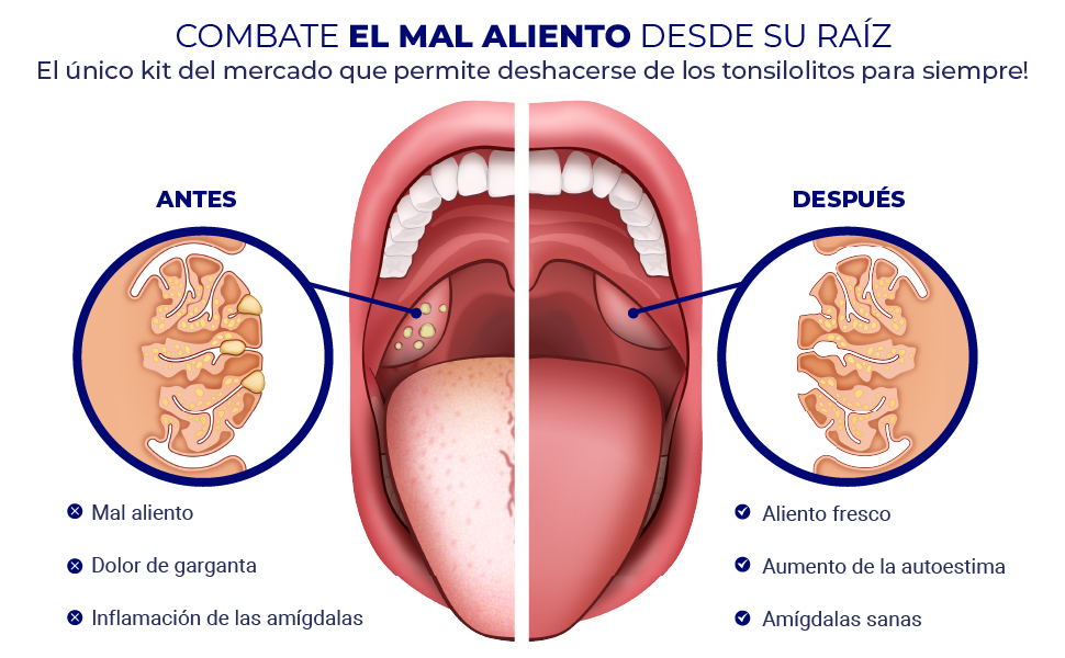 Tonsilolitos: Qué son y cómo afectan la salud bucal 2 Tonsilolitos: Qué son y cómo afectan la salud bucal