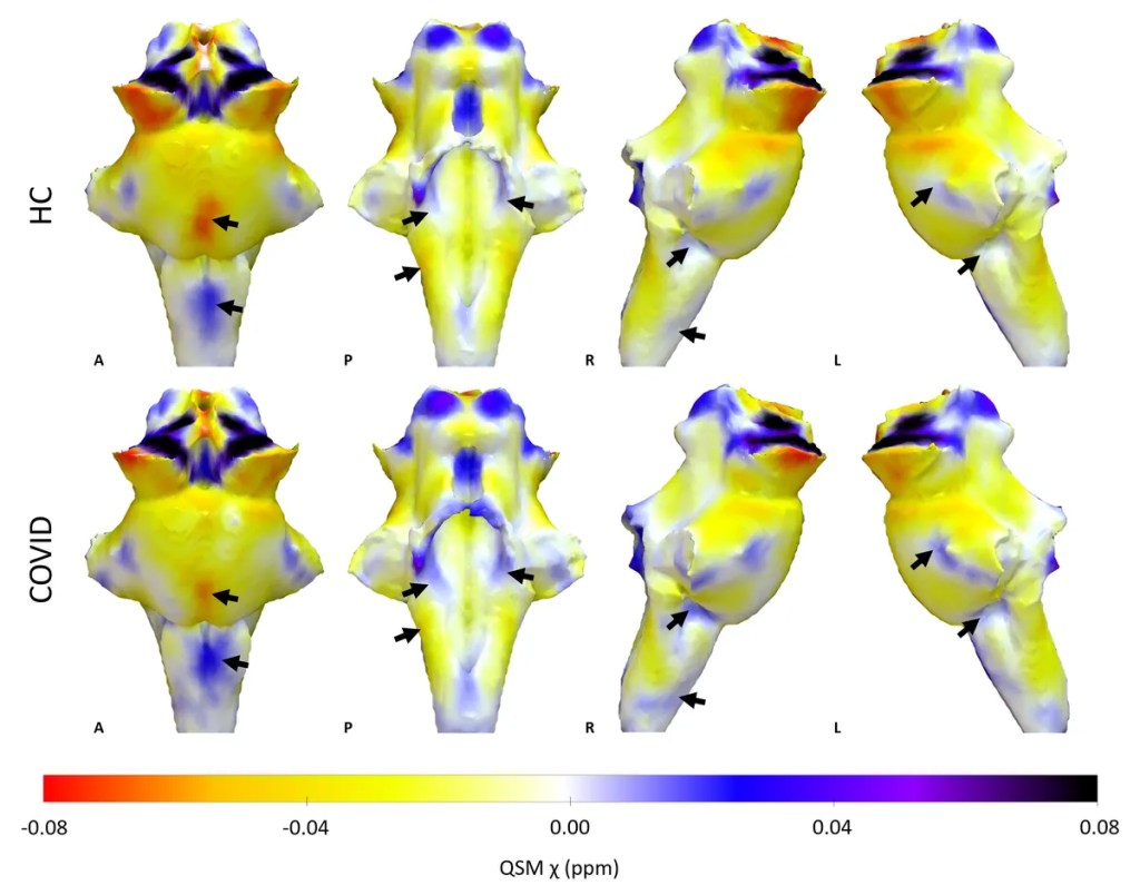 COVID-19 daña un importante centro de control del cerebro: resonancias magnéticas ultrapotentes lo revelan