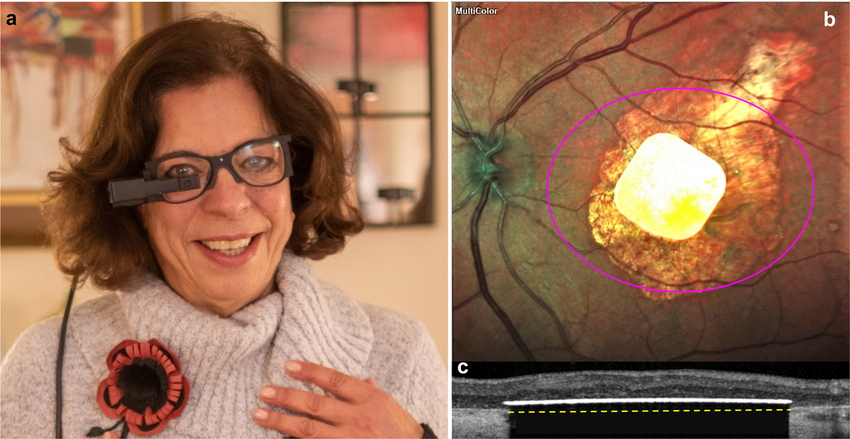 Implante ocular permite a personas con pérdida de visión leer y resolver crucigramas