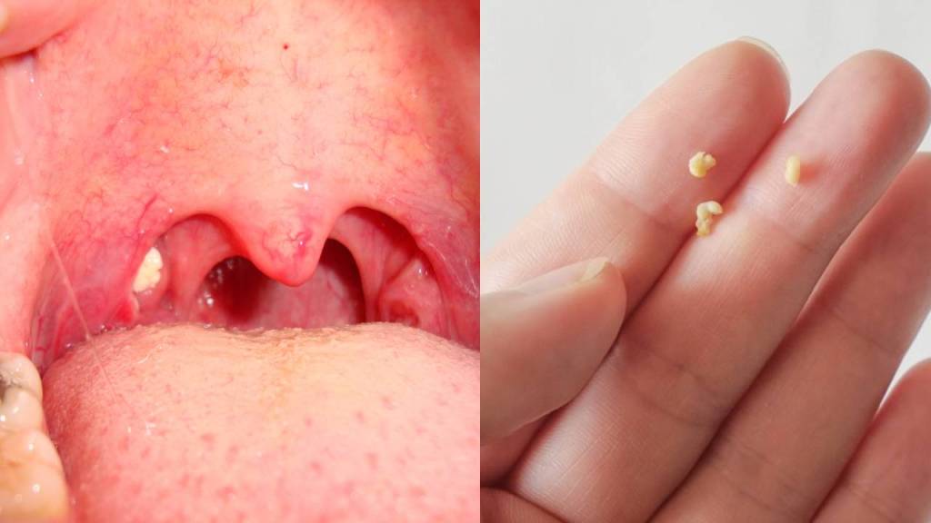 Tonsilolitos: Qué son y cómo afectan la salud bucal