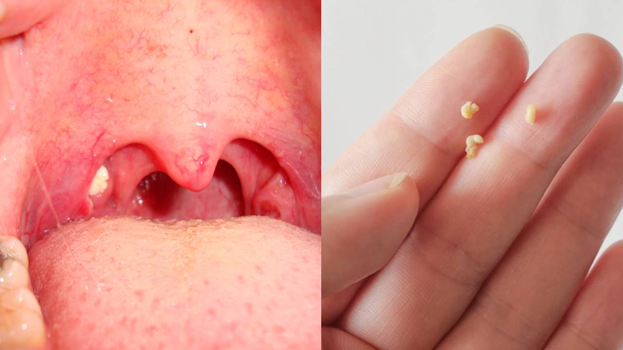 Tonsilolitos: Qué son y cómo afectan la salud bucal