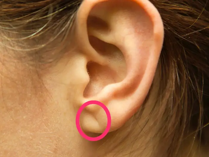 El Signo de Frank: ¿Un detector de infartos?