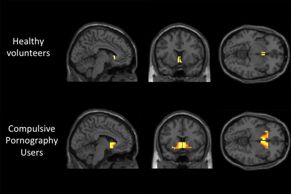 Protocolo de Andrew Huberman: Cómo reparar un cerebro saturado de dopamina