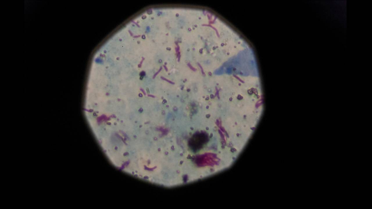 Nueva enfermedad infecciosa mortal en el mundo, y no es el COVID