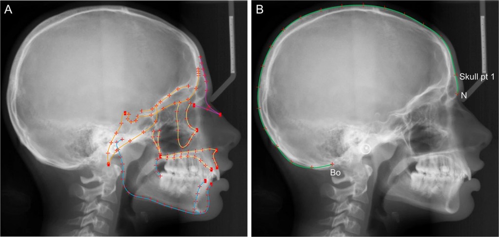 Los humanos están evolucionando para perder dientes