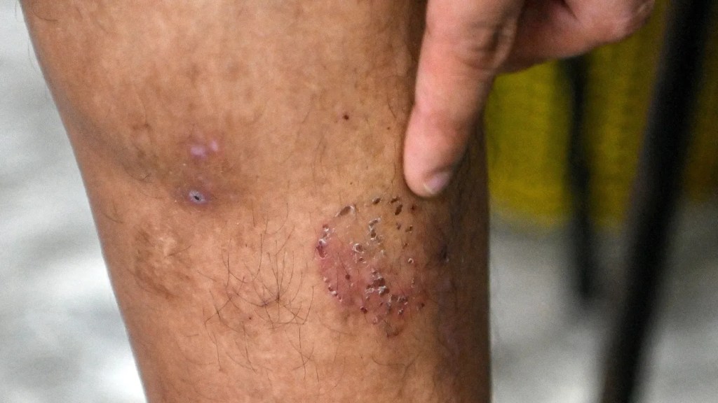 Médicos consiguen usar electricidad para curar heridas